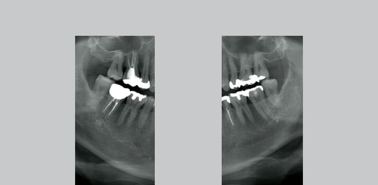 上部カットした大臼歯部の撮影