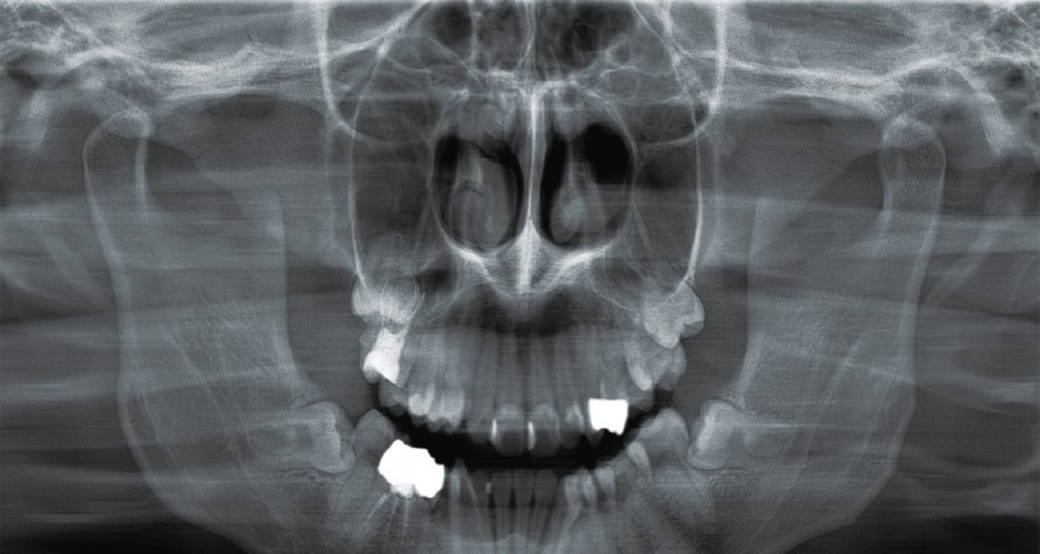 上顎洞パノラマ（後方）