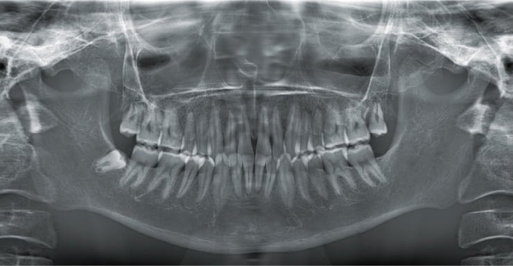 顎骨パノラマ