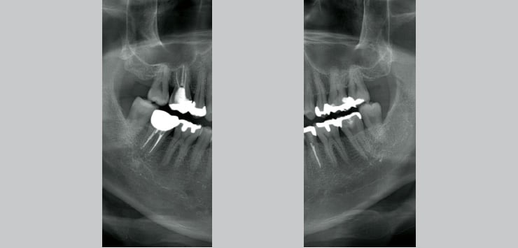 大臼歯部の撮影