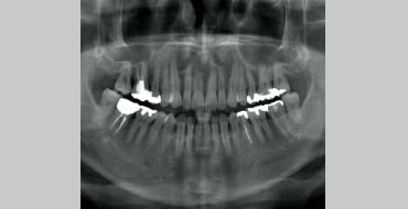 前歯部から大臼歯までの撮影