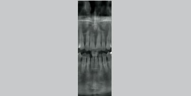 前歯部の撮影
