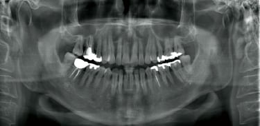 上部カットした前歯部から大臼歯部までの撮影