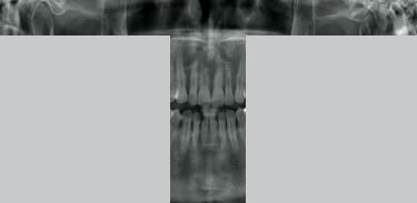 前歯部の撮影