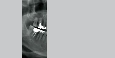 右側大臼歯部の撮影