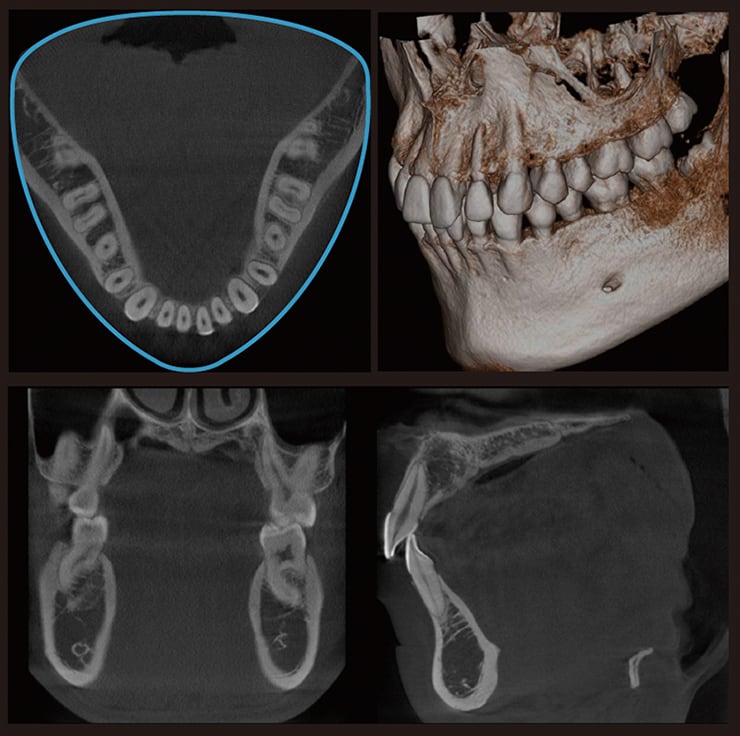 Dental-Arch FOV（X700+3D）