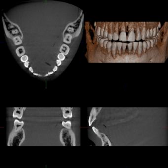 Dental Arch FOV (R100 x H40 mm)