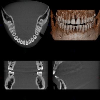 Dental Arch FOV (R100 x H50 mm)