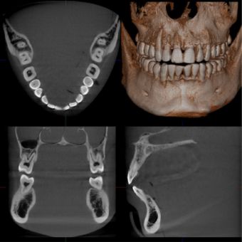Dental Arch FOV (R100 x H80 mm)