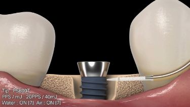 インプラント表面の歯石除去