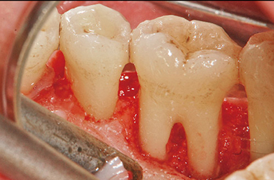 歯周外科治療における低侵襲・高効率のアプローチ