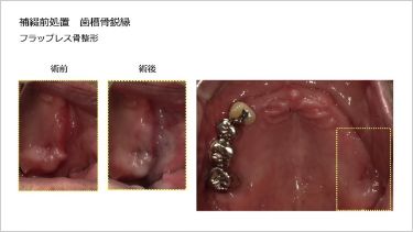 フラップレス骨切除