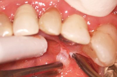 Erwin AdvErL EVO を使用した口腔軟組織の切開、切除の実際