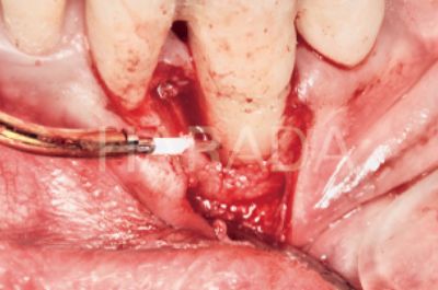 Er:YAGレーザーを使ってできる歯周骨再生の臨床例