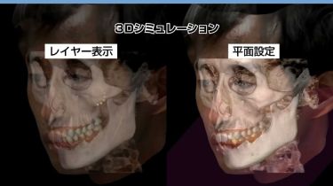3DSim｜3Dデータを統合した治療シミュレーション