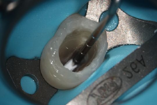 ファイバーポストの窩底部となる箇所とインスツルメントに隙間がない事を確認