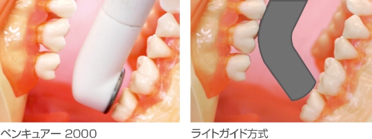 ペンキュアー2000 ペンキュアー | 株式会社 JM Ortho