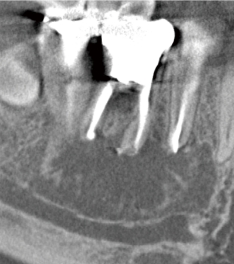 術後 (14ヵ月後)