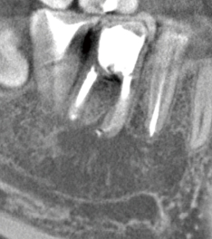 術後 (25ヵ月後)