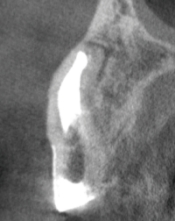 術後 (21ヵ月後)