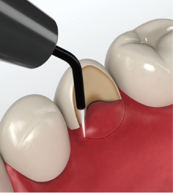 チップ電極(メス用)