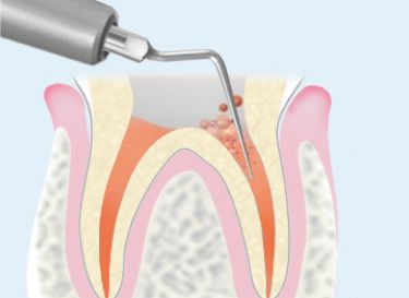 E10 ガッタパーチャ除去の使用例