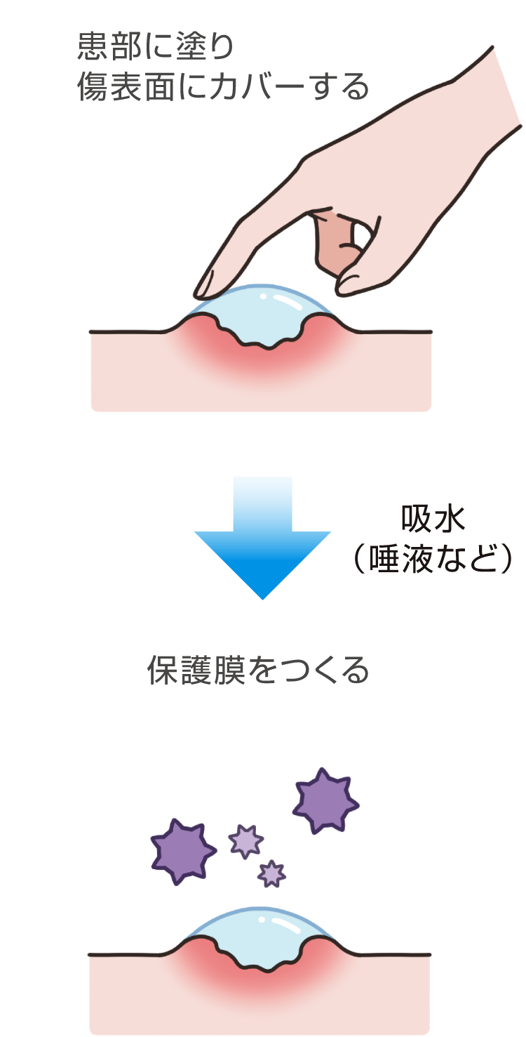 口腔粘膜の傷保護の図