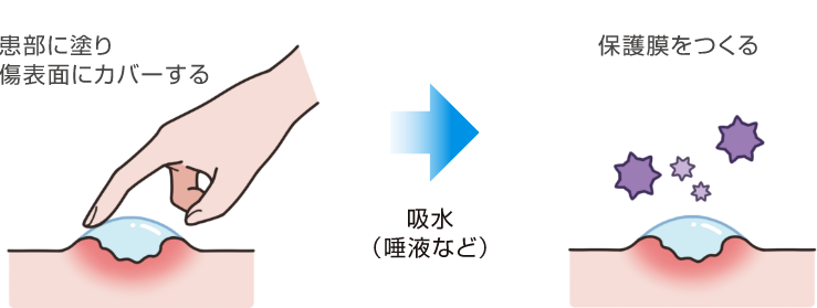 口腔粘膜の傷保護の図