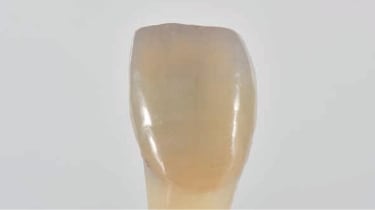 「ノリタケ カタナ® ジルコニア」YML A2で作製したクラウンを支台歯（メタルコア）に装着した状態。支台歯色の影響により、明度低下が確認できる。