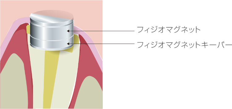 フィジオマグネット/フィジオマグネットキーパー