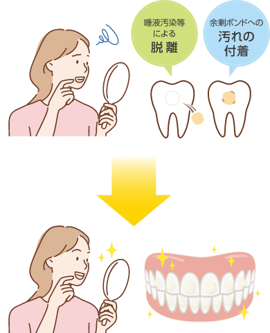 唾液汚染などによる脱離・余剰ボンドへの汚れの付着が綺麗になるイラストイメージ