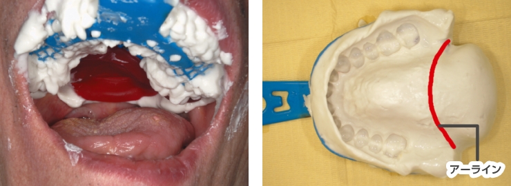 上顎総義歯の後縁を設定する際に目安となるランドマークのアーラインを越えた軟口蓋部の印象採得。咽頭部付近の印象でも、喉の奥に流れ込まず印象採得が行えます。