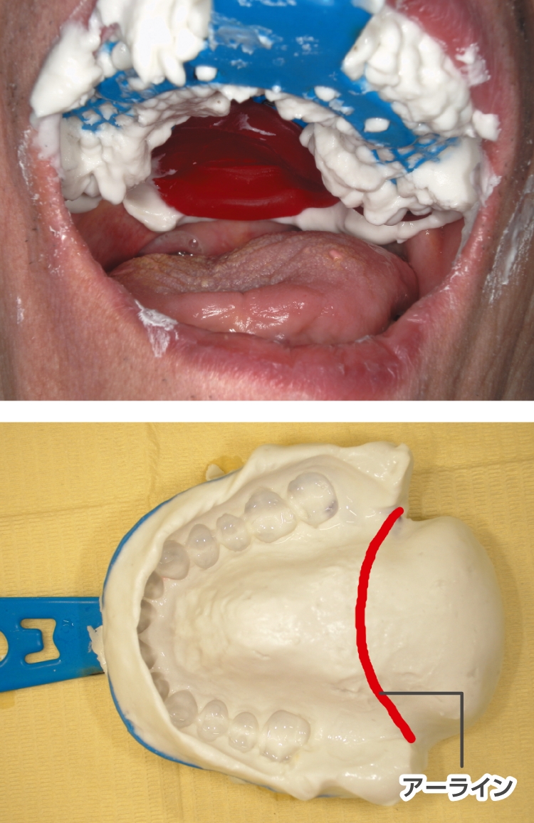 上顎総義歯の後縁を設定する際に目安となるランドマークのアーラインを越えた軟口蓋部の印象採得。咽頭部付近の印象でも、喉の奥に流れ込まず印象採得が行えます。