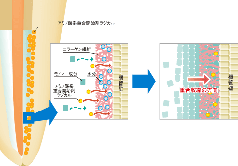 BPOフリーの独自のアミノ酸系重合開始剤を採用