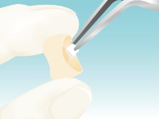 修復物に混合液を塗布のイメージ