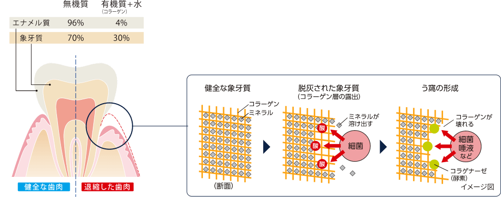 根面う蝕の発症メカニズム