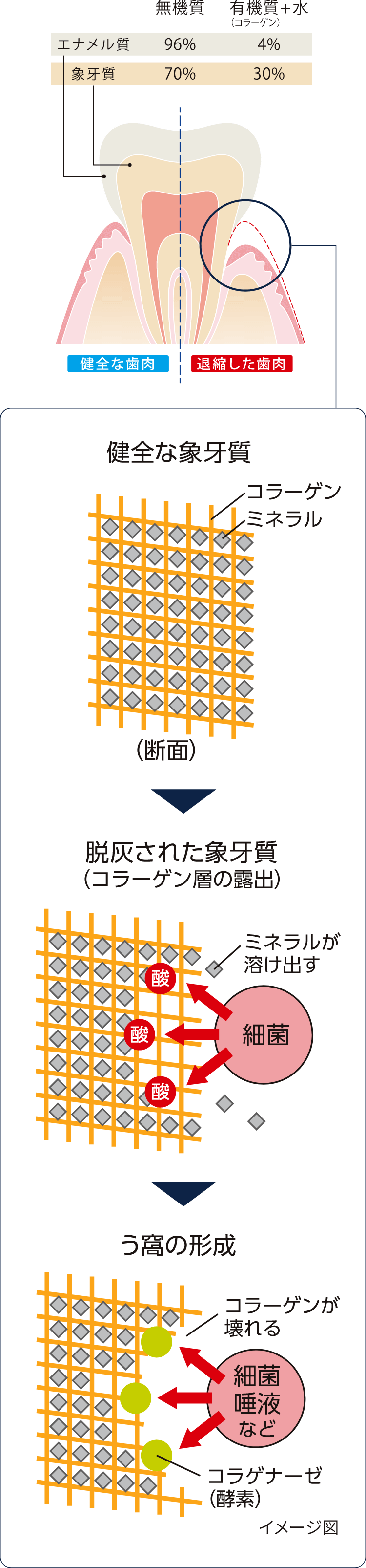 根面う蝕の発症メカニズム