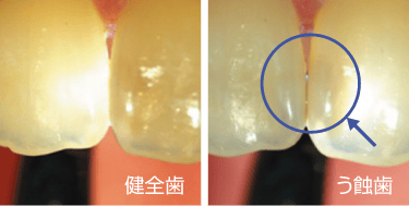 前歯のう蝕