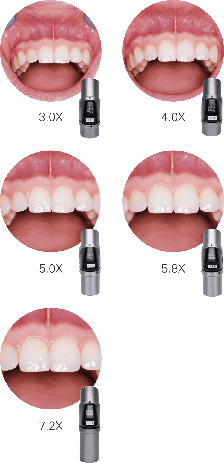 ルーペ倍率と視野のイメージ