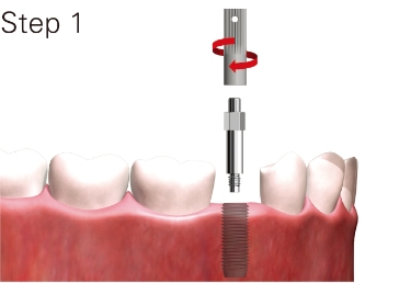 スマートペグをインプラント体に装着