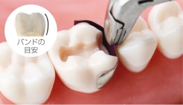 Step1　窩洞形成後、歯牙の高さにあったバンドを選択しマトリックスフォーセップスを用いて挿入します。