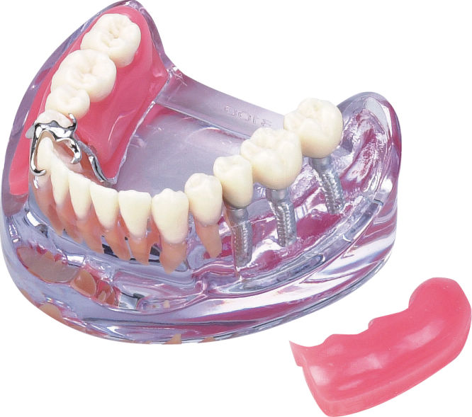 透明歯列模型 PE-PDI002 - オーラルケア 